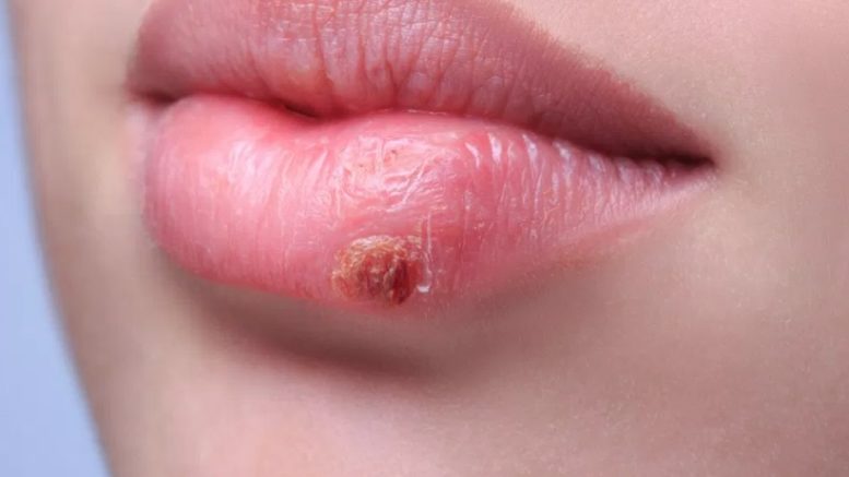 Dans quels cas se faire prescrire de l’aciclovir ?